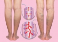 Θρόμβωση: 40% των Ασθενών με Κιρσούς καταλήγουν με Θρόμβωση στο Πόδι